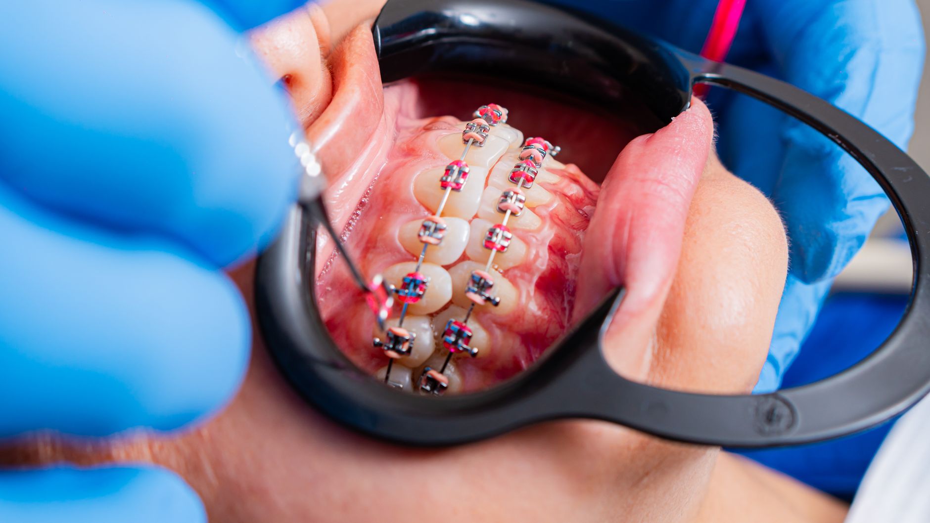 Understanding Orthodontic Care: A Guide for Beginners